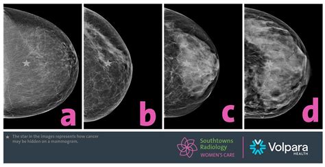 New Breast Mammography Standards Aim To Help With Early Cancer