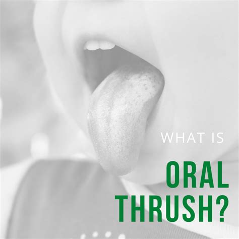 What Is Oral Thrush Acorn Dentistry For Kids