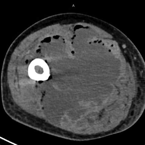 Ct Scan With Intravenous Injection Of Contrast Medium Showing The
