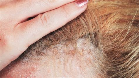 Scalp Psoriasis Causes And Treatment Goodrx