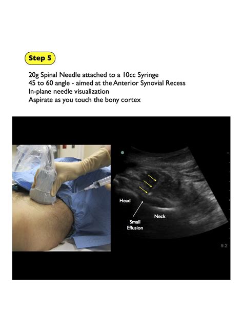 Arthrocentesis Hip — Highland Em Ultrasound Fueled Pain Management