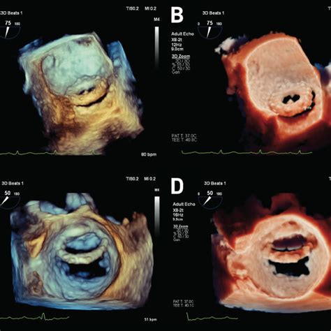 Panels A And B 3m Starr Edwards Mitral Prosthesis Dehiscence Viewed