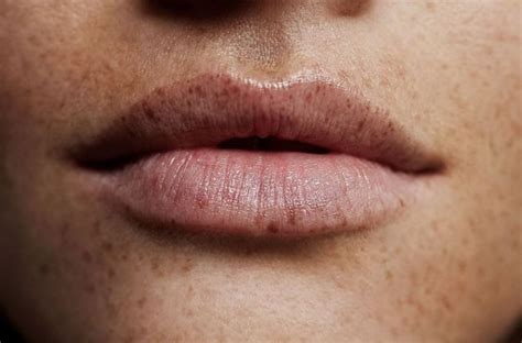 Uncovering The Rarity Of Freckles On The Lips Justinboey