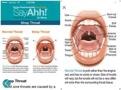 sore throat vs strep throat strep throat throat strep throat symptoms