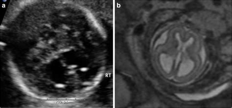 Imaging Diagnosis Of Mild Ventriculomegaly Axial Images Derived From