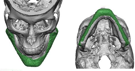 3d Ct Scan Of Custom Jawline Implant Placement Top And Bottom Views Dr
