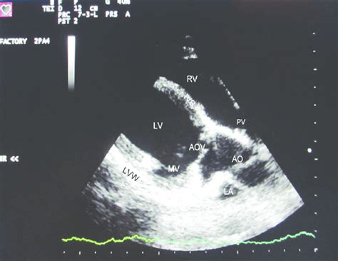 Echocardiogram Showing Right Parasternal Long Axis Left Ventricular