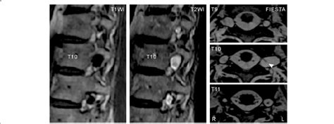 Magnetic Resonance Images At T9 T11 Showing Multiple Perineural Cysts