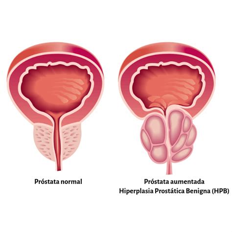 Próstata Aumentada Cuidados e Tratamentos