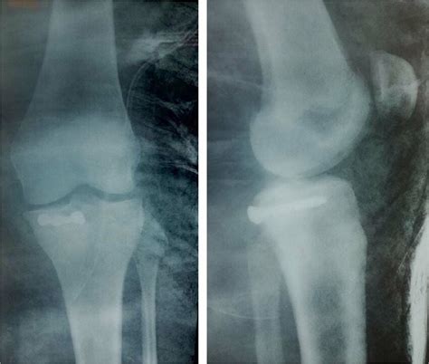 Lateral And Anteroposterior Postoperative Radiographs Of The Left Knee