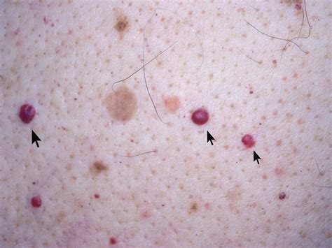 Cherry angioma is small reddish bumps that occur on the skin. Vascular Tumors - Cardiovascular - Medbullets Step 1