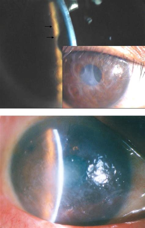 A Novel Variant Lattice Corneal Dystrophy Caused By Association Of
