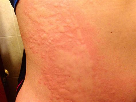 Severe Case Of Hives Urticaria Also Known As Hives Pinterest