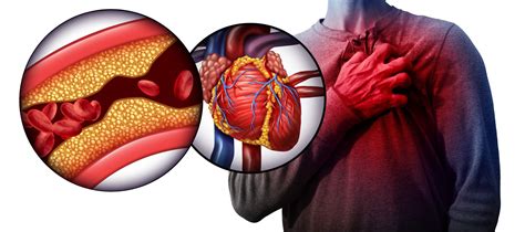 Heart Disease Types Symptoms And Causes Cvg Cares