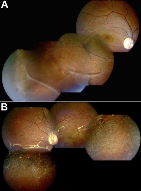 Fundus Photography Of Patient 5 With X Linked Juvenile Retinoschisis