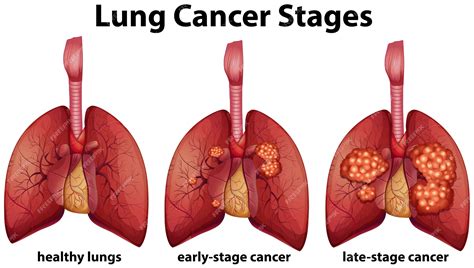 Premium Vector Diagram Showing Lung Cancer Stages