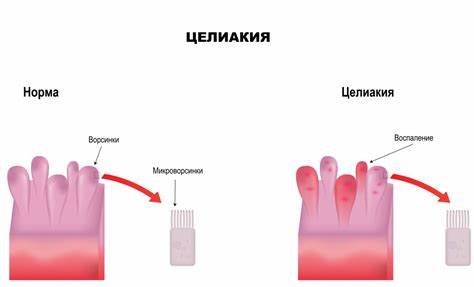 Целиакия несоблюдение диеты Целиакия - причины появления, симптомы заболевания, диагностика и Целиакия - причины появления, симптомы заболевания, диагностика и Целиакия несоблюдение диеты