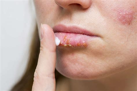 Sun Blisters On Lips Vs Herpes Lipstutorial Org