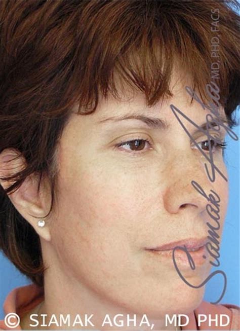 Facelift Before And After Photos By Siamak Agha Md Phd Facs Newport Beach Ca Case 43834 Asps