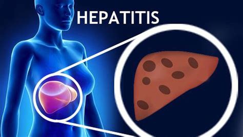 Hepatitis Tipos Causas Y Prevenci N