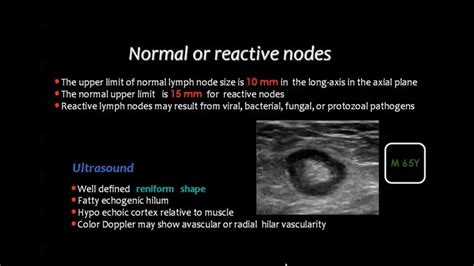 What Does Lymph Node Ultrasound Show Whatodi