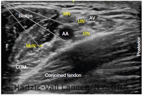 Ultrasound Guided Axillary Brachial Plexus Block Nysora The New York