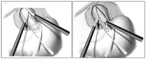 Heller Pinotti A Modified Partial Fundoplication Associated With