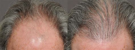 Fut Before After Photos Patient Rochester Buffalo Syracuse