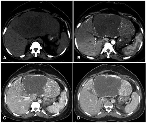 A D Axial Images Of Contrast Enhanced Ct Of The Abdomen A