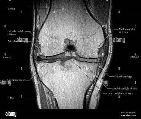 Imagen De Resonancia Magnética Coronal Fotografías E Imágenes De Alta