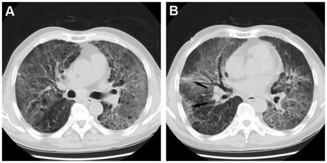 Radiation Fibrosis Lung