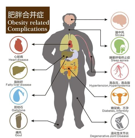 为什么癌症“偏爱”胖子？原因竟是 胆囊癌 癌症 腹型 肥胖 超重 健康界