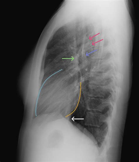 Chest X Ray Anatomy For Medical Students
