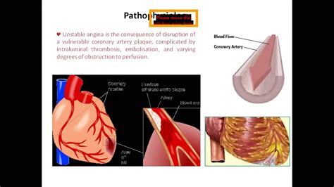 It's a treatment option for both unstable angina as well as stable. Unstable Angina by Dr. Adyle Mahmood sir - YouTube