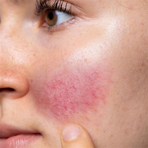 Koru Clinic Rosacea