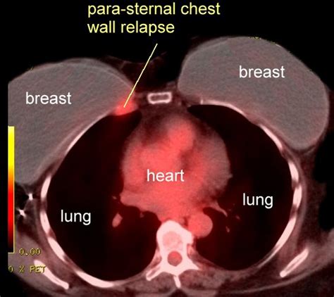 Mastectomy Breast Cancer Recurrence After Mastectomy