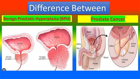 Benign Prostatic Hyperplasia Bph And Prostate Cancer Youtube