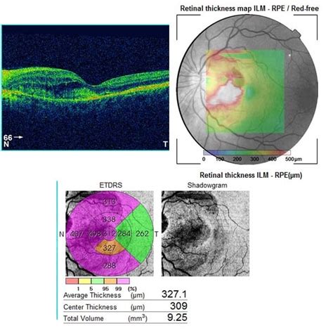Angioid Streaks And Cnv Fig 5 Retina Image Bank