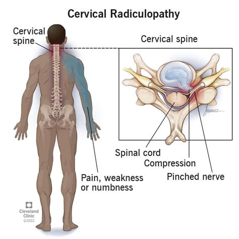 Cervical Radiculopathy Pinched Nerve In Neck Symptoms And Treatment