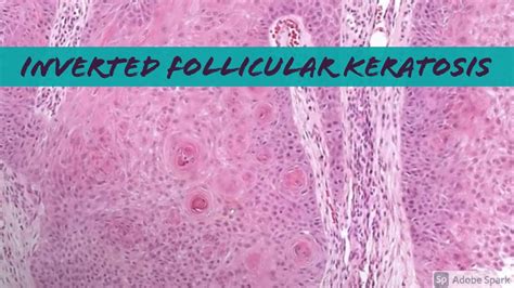 Inverted Follicular Keratosis Ifk 5 Minute Pathology Pearls Youtube