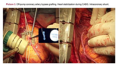 Synchronous Off Pump Coronary Artery Bypass Grafting And