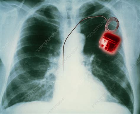 Heart Pacemaker X Ray Stock Image M5000041 Science Photo Library