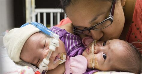 Conjoined Twin Girls In Texas Knatalye Hope And Adeline Faith Mata To