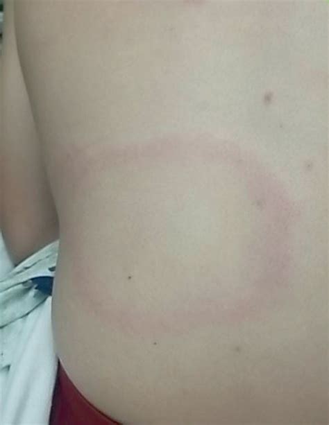 Dorsal Targetoid Lesion With Centralized Clearing Erythema Migrans