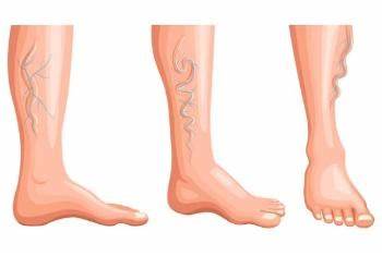 Варикоз: Причины, симптомы, диагностика и лечение варикоза — Сеть МЦ Картинка - Варикоз: Причины, симптомы, диагностика и лечение варикоза — Сеть МЦ