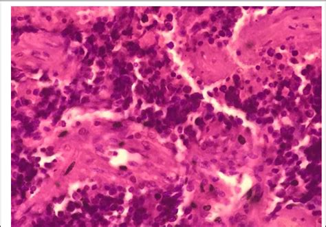 Photomicrograph Of Ewings Sarcoma Of Bone Download Scientific Diagram