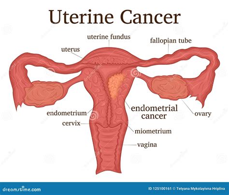 Illustration Of Uterine Cancer Stock Vector Illustration Of Endometrial Sickness