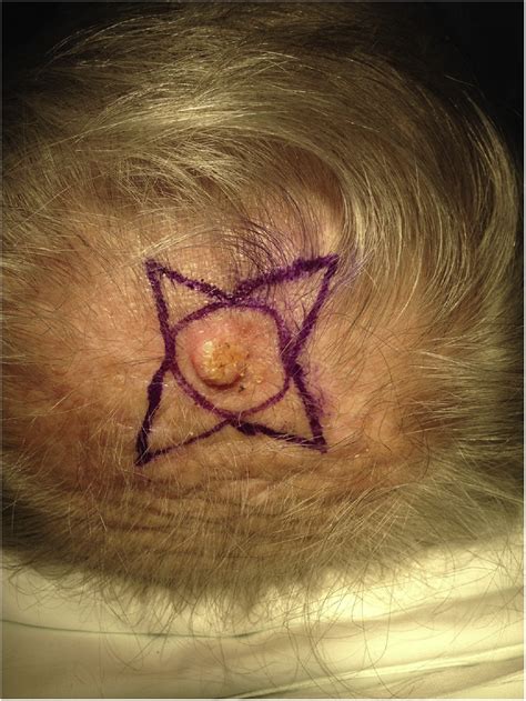 Star Flap New Reconstructive Technique For Defects Of The Scalp