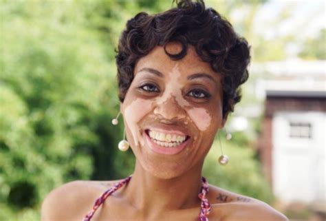 Photo Woman With Rare Skin Condition Says Men Find It Irresistible