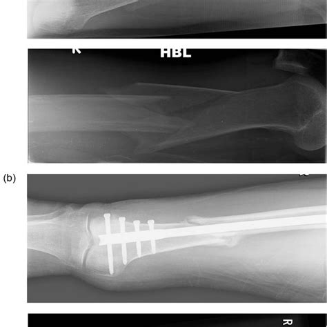 A Pre And B Post Operative Radiographs Of Distal Femur Fracture